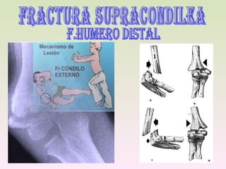 FRACTURA SUPRACONDILEA f.humero distal 