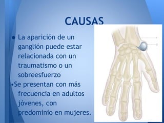 CAUSAS
• La aparición de un
  ganglión puede estar
  relacionada con un
  traumatismo o un
  sobreesfuerzo
•Se presentan con más
  frecuencia en adultos
  jóvenes, con
  predominio en mujeres.
 
