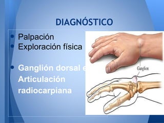 DIAGNÓSTICO
• Palpación
• Exploración física
• Ganglión dorsal en
  Articulación
  radiocarpiana
 