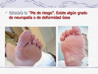 GRADO 0 :  “Pie de riesgo”. Existe algún grado de neuropatía o de deformidad ósea 