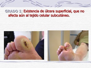 GRADO 1 :  Existencia de úlcera superficial, que no afecta aún al tejido celular subcutáneo.  