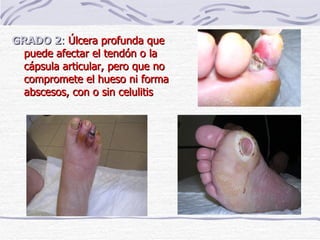 GRADO 2 :   Úlcera profunda que puede afectar el tendón o la cápsula articular, pero que no compromete el hueso ni forma abscesos, con o sin celulitis 