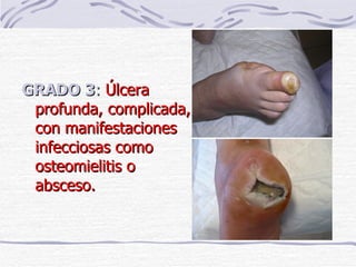 GRADO 3 :  Úlcera profunda, complicada, con manifestaciones infecciosas como osteomielitis o absceso. 