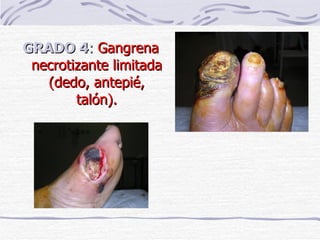 GRADO 4 :  Gangrena necrotizante limitada (dedo, antepié, talón). 