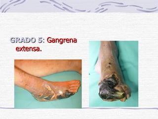 GRADO 5 :  Gangrena extensa. 