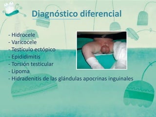 Diagnóstico diferencial

- Hidrocele
- Varicocele
- Testículo ectópico
- Epididimitis
- Torsión testicular
- Lipoma
- Hidradenitis de las glándulas apocrinas inguinales
 