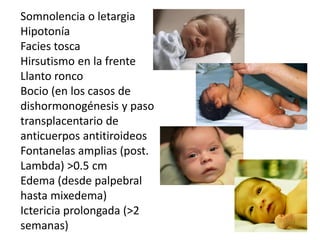 Somnolencia o letargia
Hipotonía
Facies tosca
Hirsutismo en la frente
Llanto ronco
Bocio (en los casos de
dishormonogénesis y paso
transplacentario de
anticuerpos antitiroideos
Fontanelas amplias (post.
Lambda) >0.5 cm
Edema (desde palpebral
hasta mixedema)
Ictericia prolongada (>2
semanas)
 