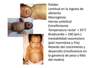 Palidez
Lentitud en la ingesta de
alimento
Macroglosia
Hernia umbilical
Estreñimiento
Temperatura rectal < 35°C
Bradicardia > 100 lpm.)
Inestabilidad vasomotora
(piel marmórea y fría)
Retardo del crecimiento y
desarrollo (insuficiencia en
la ganancia de peso y falla
del medro)
 