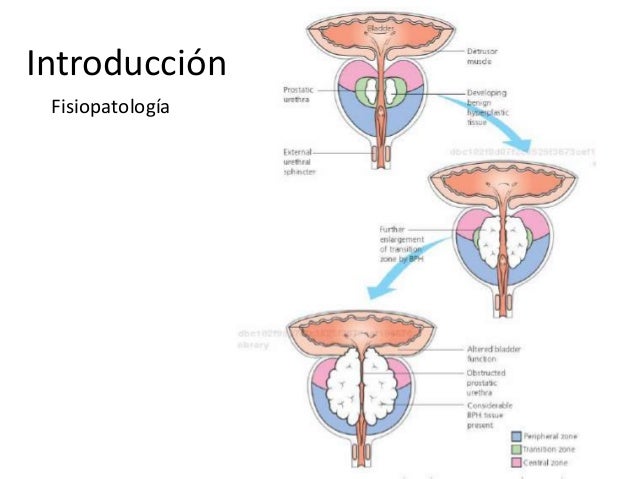 (20150217) HIPERPLASIA PROSTÁTICA BENIGNA. (PPT)
