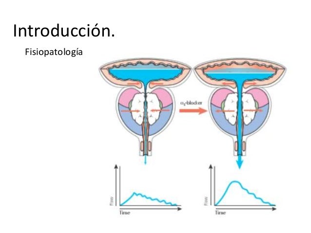 (20150217) HIPERPLASIA PROSTÁTICA BENIGNA. (PPT)