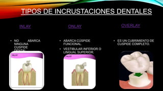 TIPOS DE INCRUSTACIONES DENTALES
INLAY
• NO ABARCA
NINGUNA
CUSPIDE
DENTAL.
ONLAY
• ABARCA CÚSPIDE
FUNCIONAL.
• VESTIBULAR INFERIOR O
LINGUAL SUPERIOR.
OVERLAY
• ES UN CUBRIMIENTO DE
CUSPIDE COMPLETO.
 