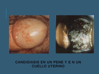 CANDIDIASIS EN UN PENE Y E N UN 
CUELLO UTERINO 
 