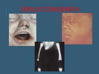SIFILIS CONGENITA 
 