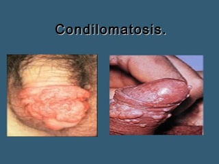 CCoonnddiilloommaattoossiiss.. 
 