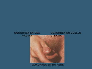 GONORREA EN UNA 
VAGINA 
GONORREA EN CUELLO 
UTERINO 
GONORREA EN UN PENE 
 