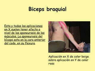 Biceps braquial
Esta y todas las aplicaciones
en X suelen tener efecto a
nivel de las aponeurosis de los
músculos. La aponeurosis del
bíceps esta en la cara anterior
del codo, en su flexura.
Aplicación en X de color beige
sobre aplicación en Y de color
rosa
 