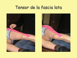 Tensor de la fascia lata
 