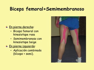 Biceps femoral+Semimembranoso
En pierna derecha:
– Biceps femoral con
kinesiotape rosa
– Semimembranoso con
kinesiotape beige
En pierna izquierda:
– Aplicación combinada
(bíceps + semi).
 