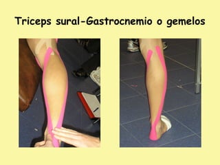 Triceps sural-Gastrocnemio o gemelos
 