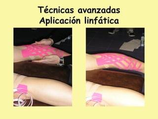 Técnicas avanzadas
Aplicación linfática
 