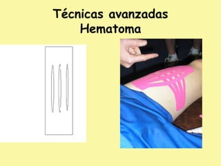 Técnicas avanzadas
Hematoma
 