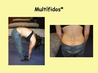 Multífidos*
 