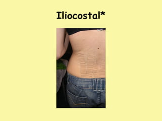 Iliocostal*
 