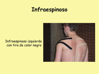 Infraespinoso
Infraespinoso izquierdo
con tira de color negro
 
