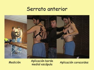 Serrato anterior
Medición Aplicación coracoides
Aplicación borde
medial escápula
 