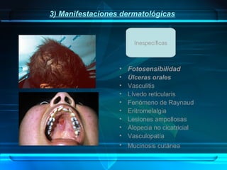 3) Manifestaciones dermatológicas

Inespecíficas

•
•
•
•
•
•
•
•
•
•

Fotosensibilidad
Úlceras orales
Vasculitis
Lívedo reticularis
Fenómeno de Raynaud
Eritromelalgia
Lesiones ampollosas
Alopecia no cicatricial
Vasculopatía
Mucinosis cutánea

 