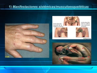 1) Manifestaciones sistémicas/musculoesqueléticas

 