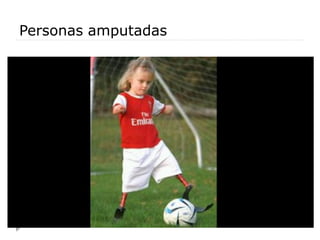 Personas amputadas
 