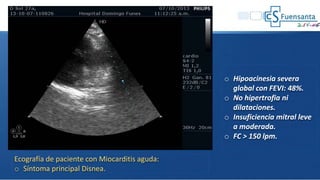 o Hipoacinesia severa
global con FEVI: 48%.
o No hipertrofia ni
dilataciones.
o Insuficiencia mitral leve
a moderada.
o FC > 150 lpm.
Ecografía de paciente con Miocarditis aguda:
o Síntoma principal Disnea.
 