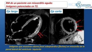 Imágenes que muestran edema focal subepicárdico (flechas) en miocardio de la
pared lateral del ventrículo izquierdo
Eje largo Eje corto
RM de un paciente con miocarditis aguda:
Imágenes potenciadas en T2.
 