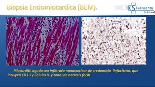 Miocarditis aguda con infiltrado mononuclear de predominio linfocitario, que
incluyen CD3 + y Células B, y zonas de necrosis focal
 