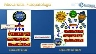 Miocarditis aguda
Producción de
anticuerpos
Miocarditis subaguda
Miocitos dañados
virus
cardiotrópicos
 