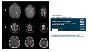 Accidente cerebrovascular isquémico durante coinfección por dengue
y Plasmodium vivax en una mujer joven: informe de un caso -
https://link.springer.com/article/10.1186/s12936-026-05838-8/figures/1
 