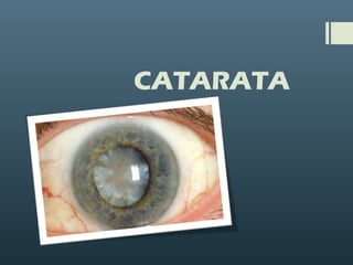 CATARATA
 