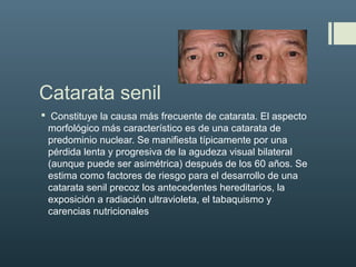 Catarata senil
 Constituye la causa más frecuente de catarata. El aspecto
morfológico más característico es de una catarata de
predominio nuclear. Se manifiesta típicamente por una
pérdida lenta y progresiva de la agudeza visual bilateral
(aunque puede ser asimétrica) después de los 60 años. Se
estima como factores de riesgo para el desarrollo de una
catarata senil precoz los antecedentes hereditarios, la
exposición a radiación ultravioleta, el tabaquismo y
carencias nutricionales
 
