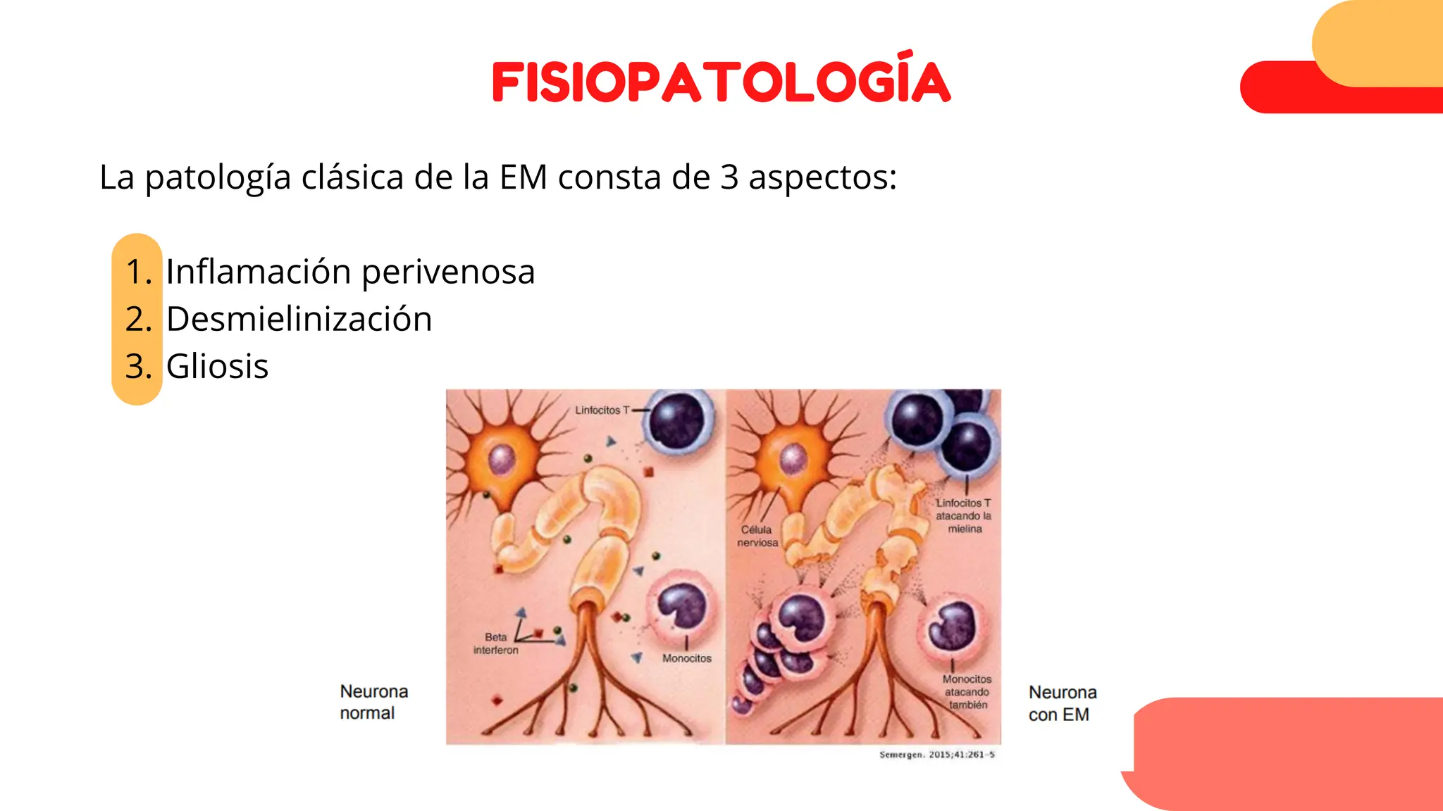 FISIOPATOLOGÍA
Inflamación perivenosa
Desmielinización
Gliosis
La patología clásica de la EM consta de 3 aspectos:
1.
2.
3.
 