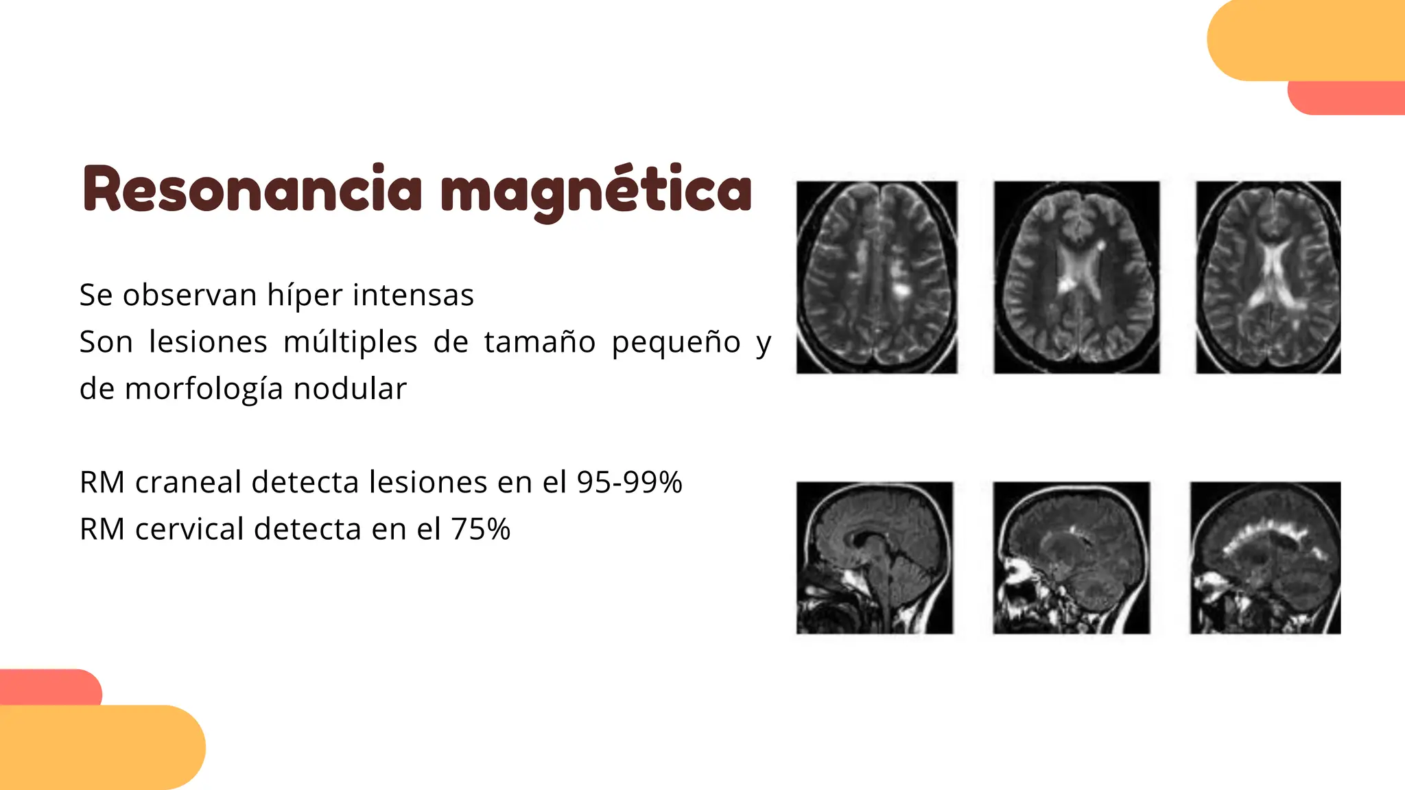 Resonancia magnética
Se observan híper intensas
Son lesiones múltiples de tamaño pequeño y
de morfología nodular
RM craneal detecta lesiones en el 95-99%
RM cervical detecta en el 75%
 