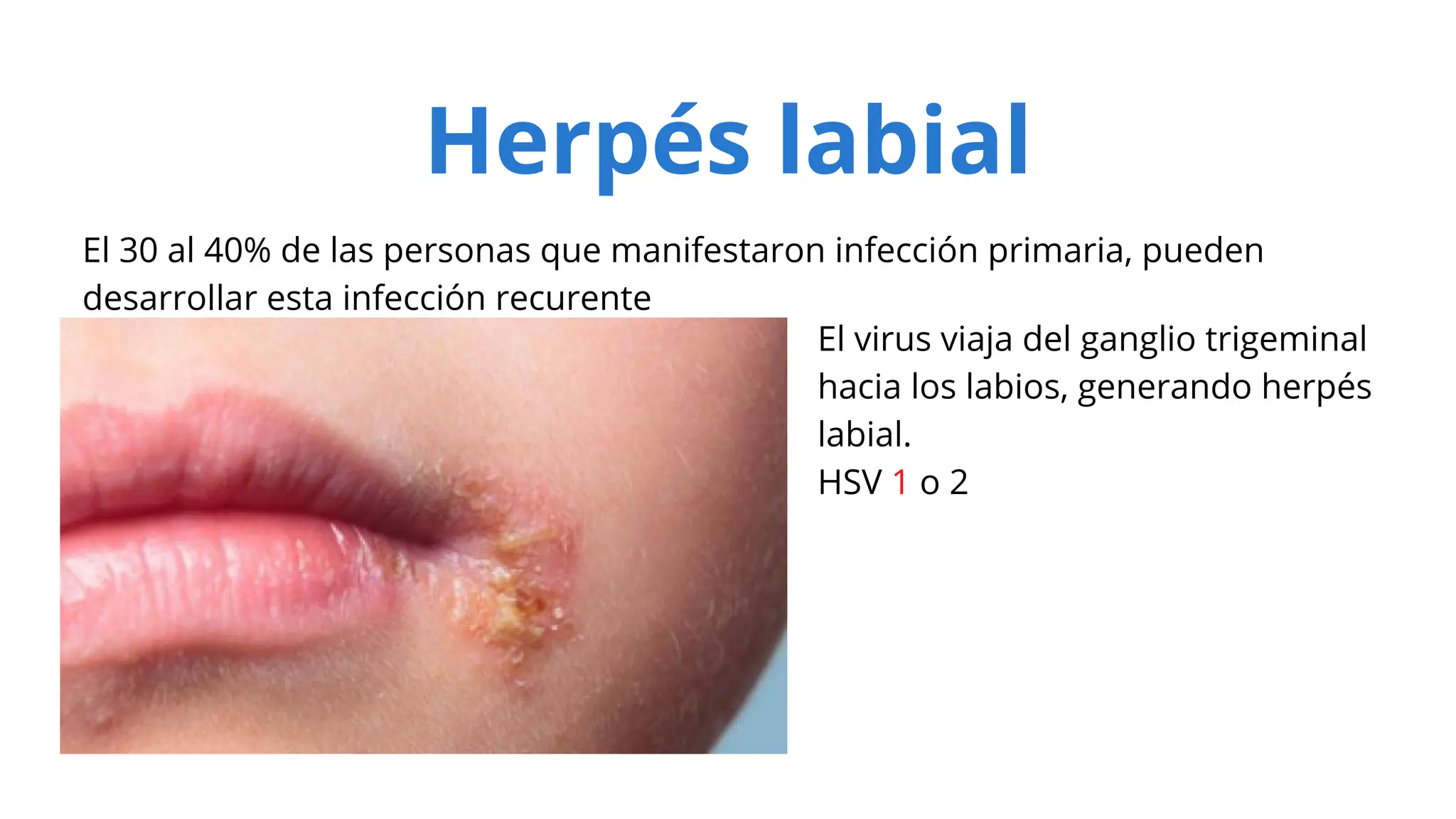 Virus del Herpes, tipos, clasificación, cuadro clínico, etc. | PPT