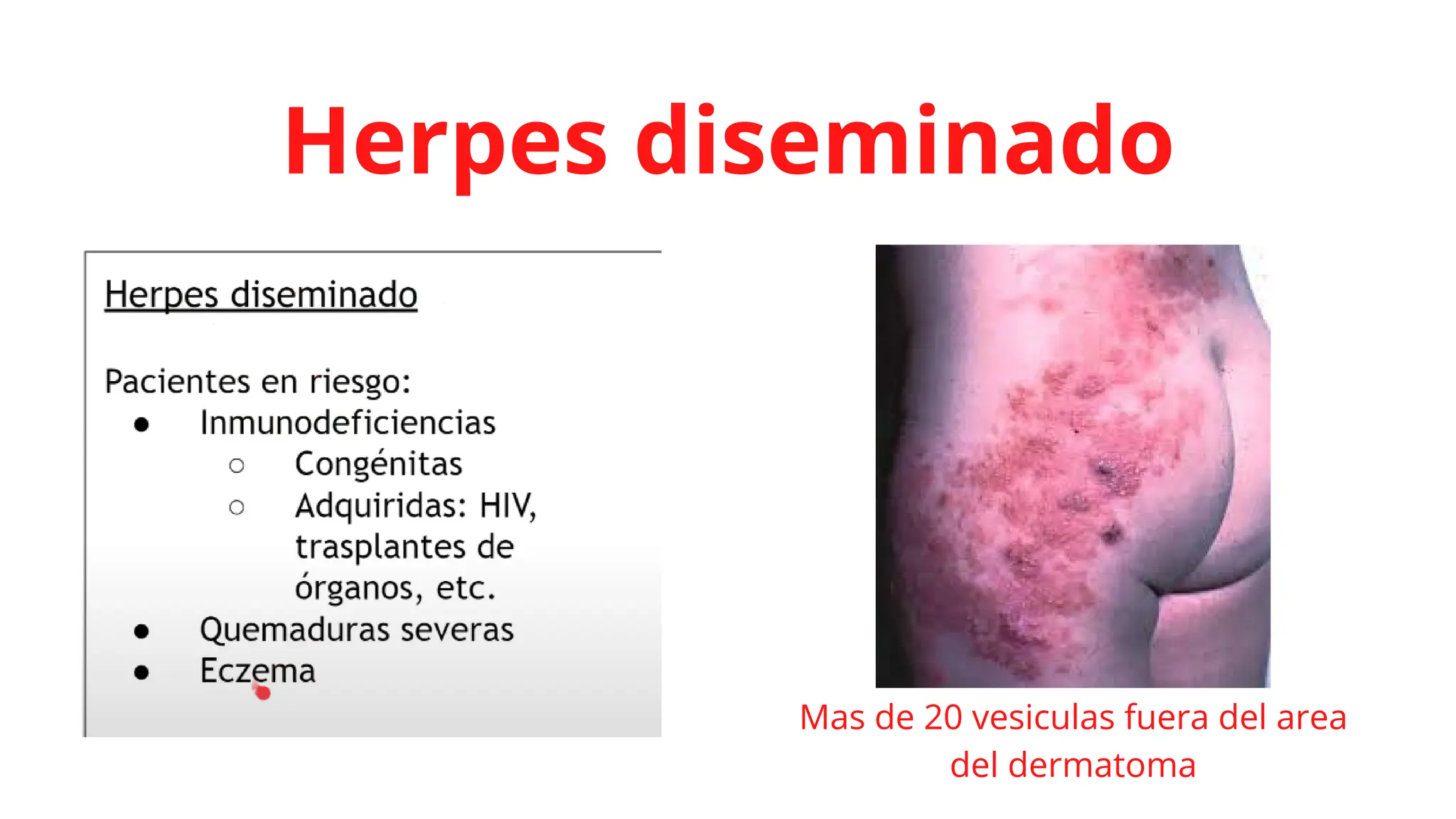 virus-del-herpes-tipos-clasificaci-n-cuadro-cl-nico-etc-pdf