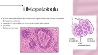 Histopatologia
Islotes de células basaloides con núcleos hipercromáticos, escaso citoplasma
Empalizada periférica
Separación (clefting) entre el estroma tumoral y los islotes
celulares
Estroma mucinoso
 