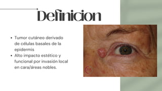 Definicion
Tumor cutáneo derivado
de células basales de la
epidermis
Alto impacto estético y
funcional por invasión local
en cara/áreas nobles.
 