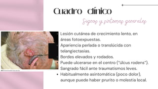 Cuadro clínico
Lesión cutánea de crecimiento lento, en
áreas fotoexpuestas.
Apariencia perlada o translúcida con
telangiectasias.
Bordes elevados y rodados.
Puede ulcerarse en el centro (“úlcus rodens”).
Sangrado fácil ante traumatismos leves.
Habitualmente asintomática (poco dolor),
aunque puede haber prurito o molestia local.
Signos y síntomas generales
 