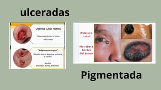ulceradas
Pigmentada
 