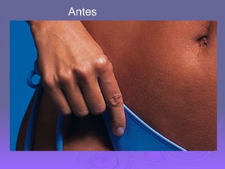Antes 