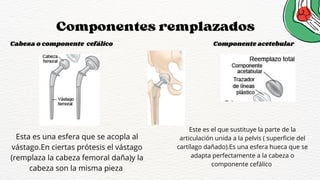Componentes remplazados
Cabeza o componente cefálico Componente acetebular
Esta es una esfera que se acopla al
vástago.En ciertas prótesis el vástago
(remplaza la cabeza femoral daña)y la
cabeza son la misma pieza
Este es el que sustituye la parte de la
articulación unida a la pelvis ( superficie del
cartílago dañado).Es una esfera hueca que se
adapta perfectamente a la cabeza o
componente cefálico
 
