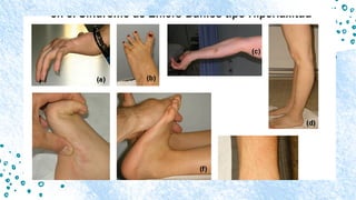 Hyperlax Back Comprehensive Overview of Síndrome de Hiperlaxitud Articular: Diagnosis ...